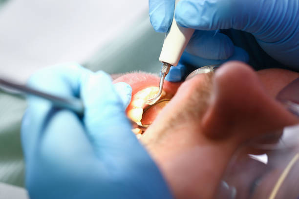 Best Knocked-Out Tooth (Avulsed Tooth) Treatment in Lindale, TX