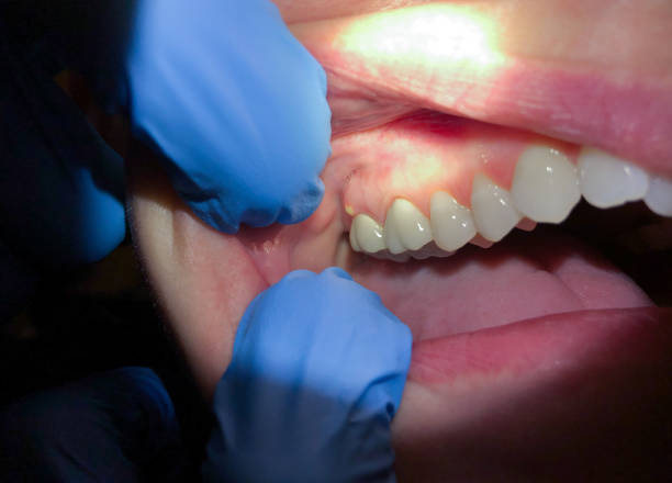 Best Emergency Cosmetic Dentistry (e.g., broken veneers) in Lindale, TX